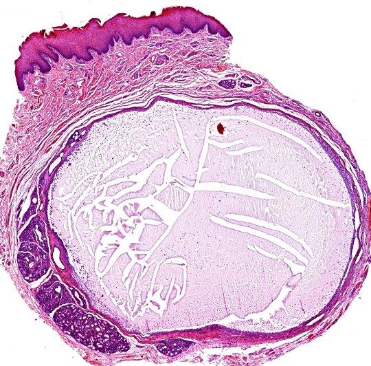 extramucocele_p0